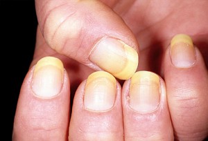 yellow nails health problems